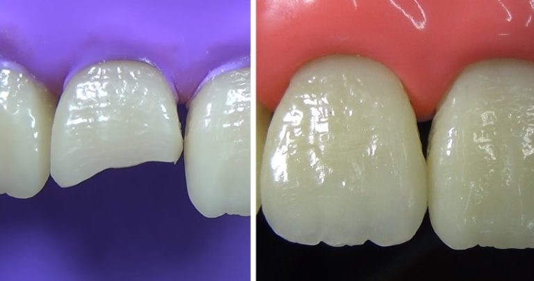 Composite Restoration Of Fractured Anterior Tooth Is Satisfying To Watch